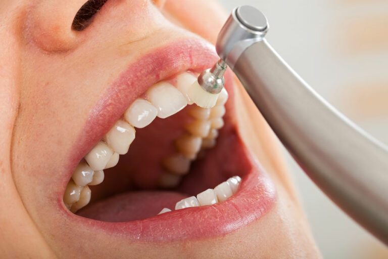 dental-polishing